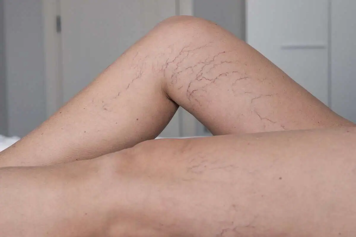 Visible spider veins on a patient's legs before sclerotherapy at PBK Medspa in Brooklyn, NY"