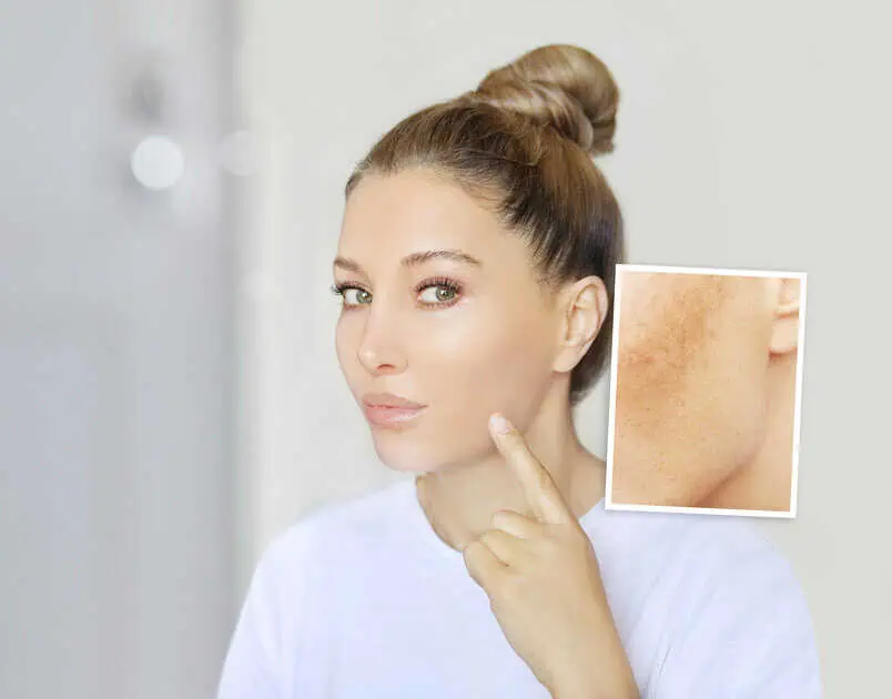 Woman with cheek pigmentation considering professional pigment removal treatment in Brooklyn, NY